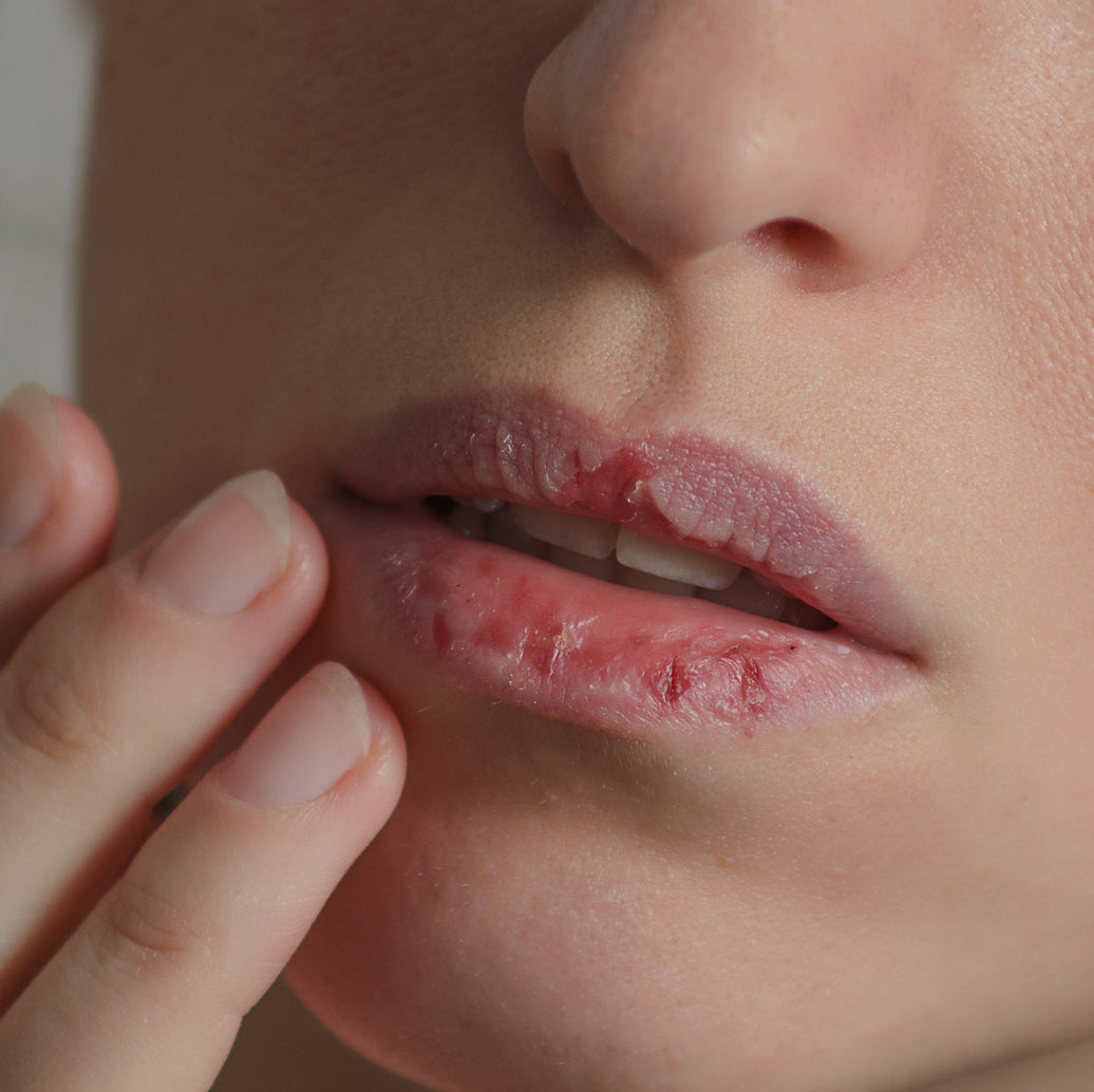 Chapstick Season Isn’t Over Yet (Here’s Why Your Lips Still Need It)